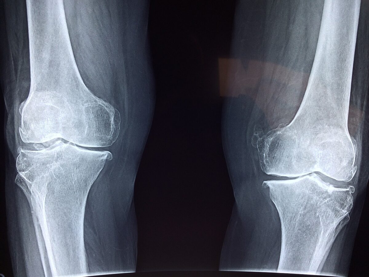 knee-2253047_1280-1200x900.jpg