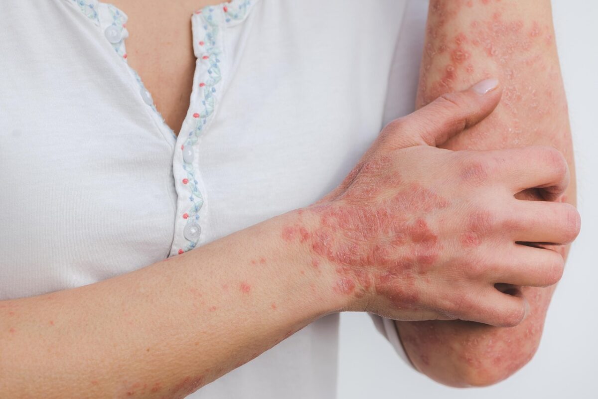 psoriasis-5996424_1280-1200x801.jpg