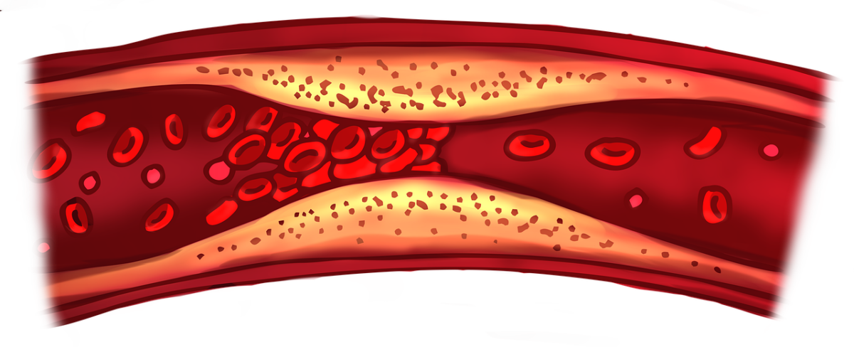 blood-clot-7118517_1280-1200x488.png