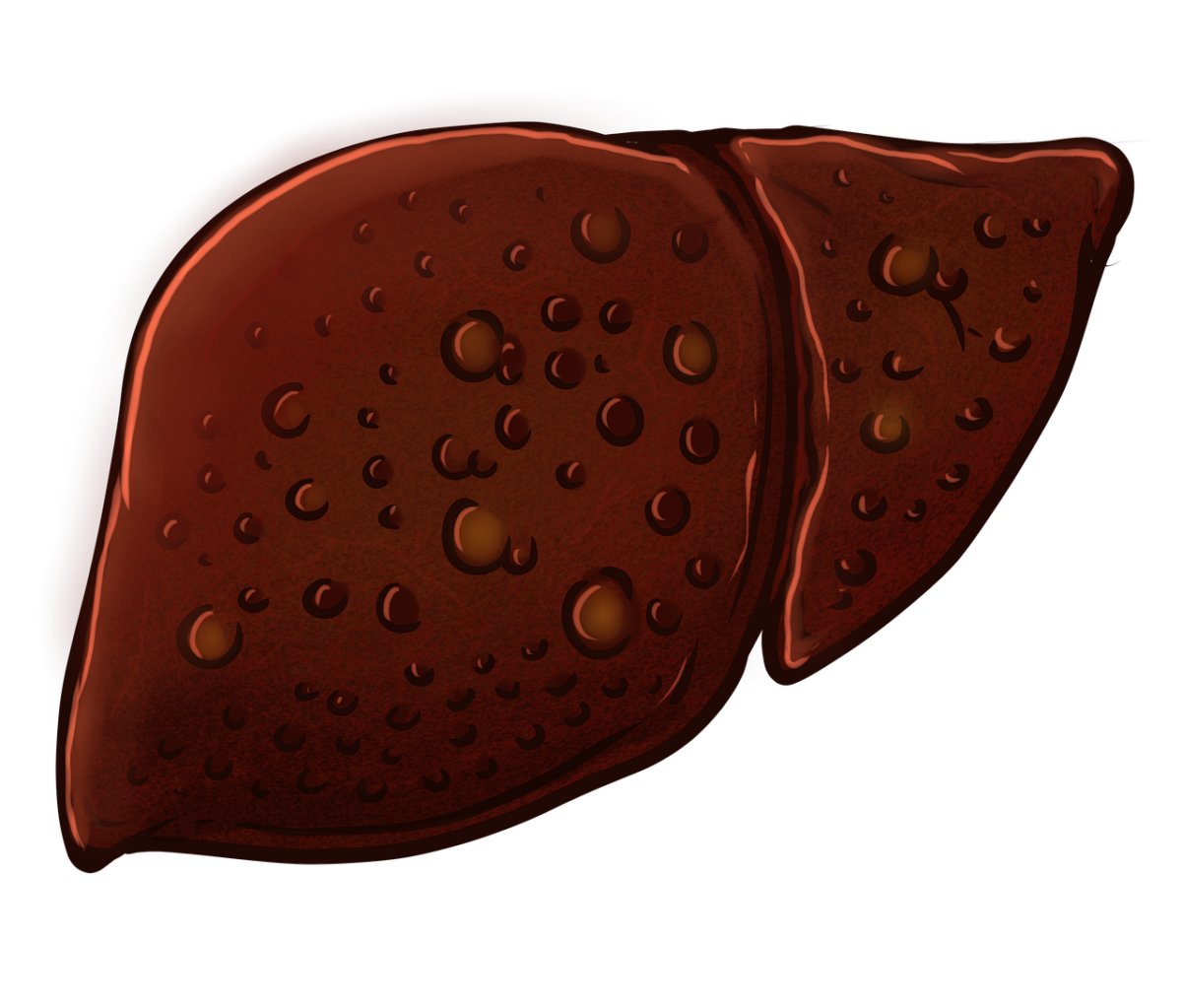 cirrhosis-9333896_1280-1200x1023.png